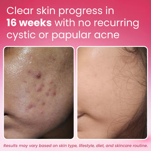 Before and after acne results showing clear skin progress in 16 weeks with no recurring cystic or papular acne, featuring Yugap Yuclear supplement benefits on a pink background.